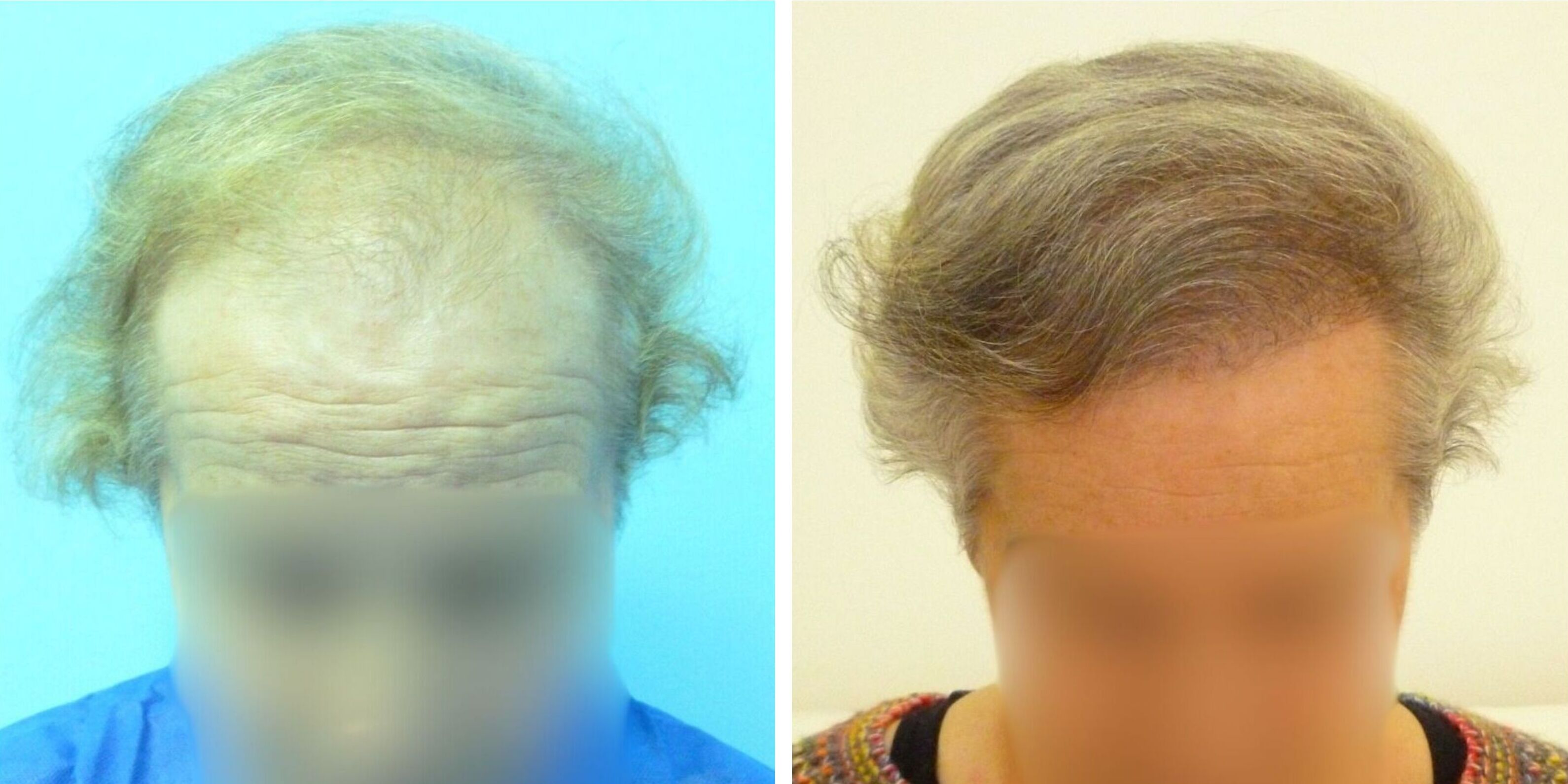 Comparativa de antes y después del injerto capilar de una mujer en Madrid