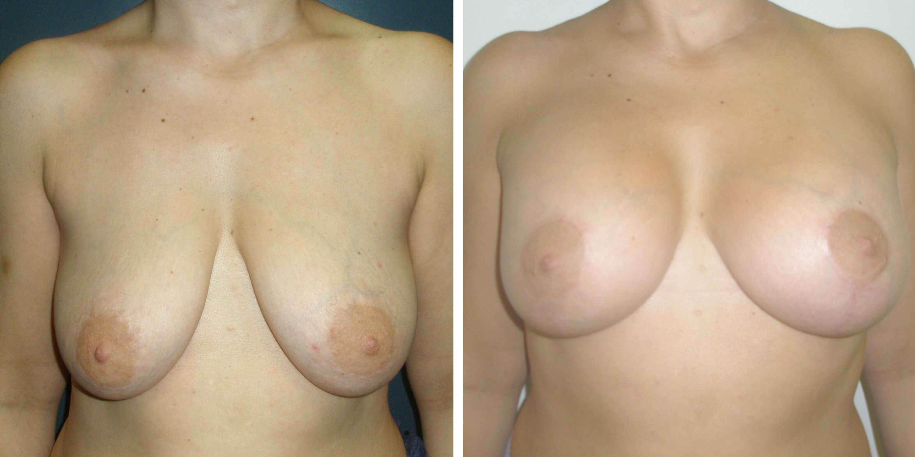 Comparativa antes y después en una mujer de una mastopexia en Madrid